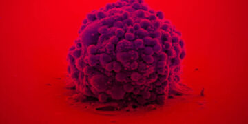 Un parche bioadhesivo, inspirado en la adhesión de los mejillones, elimina las células del tumor cerebral más letal