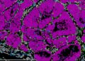 Un nuevo estudio revela que en los tumores primarios de cáncer de mama ya existen células preparadas para formar metástasis