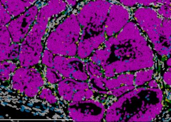 Un nuevo estudio revela que en los tumores primarios de cáncer de mama ya existen células preparadas para formar metástasis