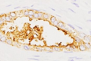 Desarrollan un prototipo de test diagnóstico para detectar el cáncer de páncreas en minutos con una muestra de sangre