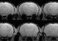 Un fragmento de anticuerpo previene las hemorragias típicas de los nuevos tratamientos para la enfermedad de Alzheimer
