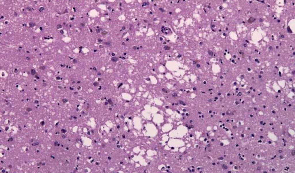 1967_971px-cjd_spongiosis_temporal_lobe