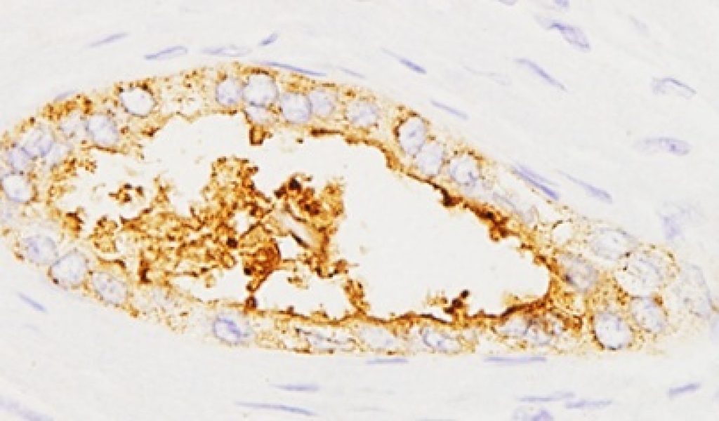 Cancer_pancrees_web