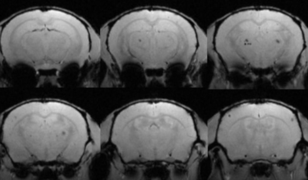 CervellAlzheimerIM