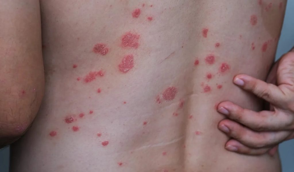 Psoriasis