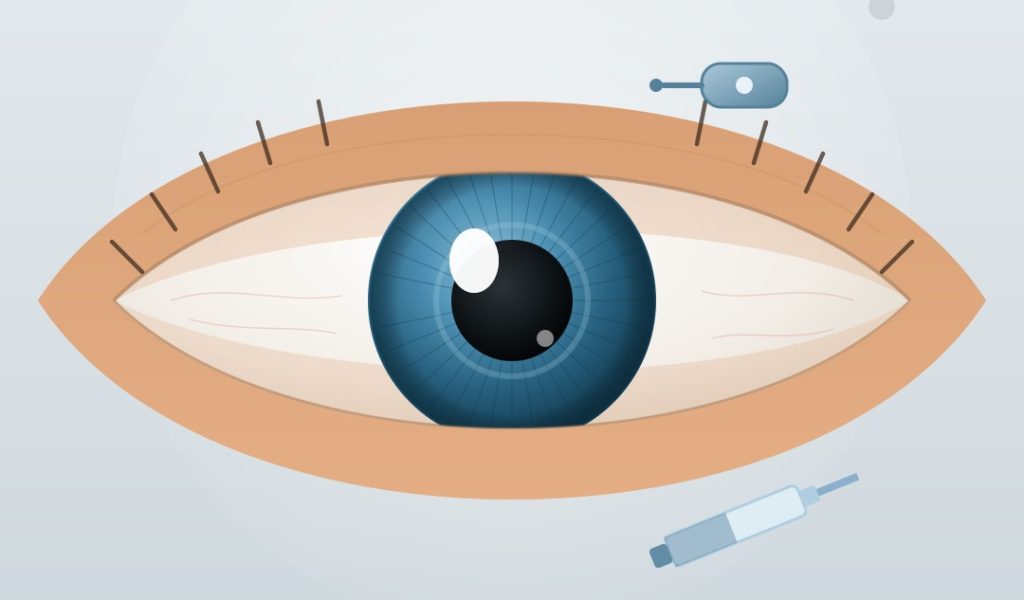 dmae_tratamiento_ilustracion