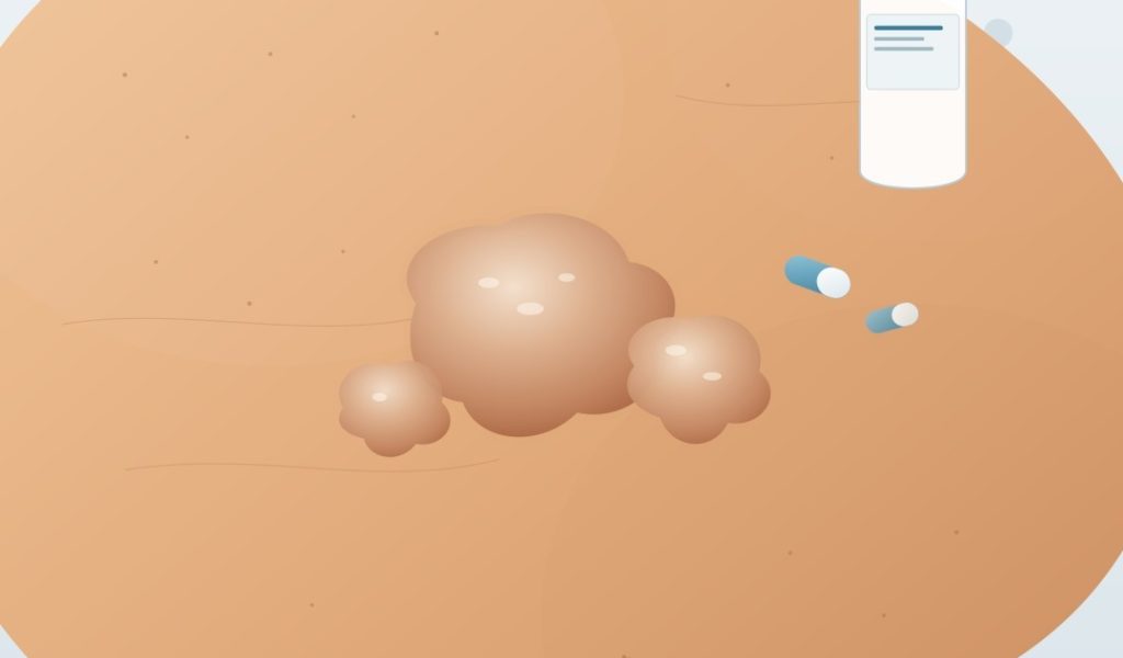 psoriasis_tratamiento 2